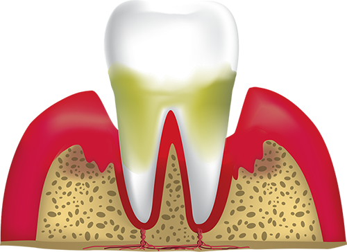 advanced periodontitis, Falmouth, MA