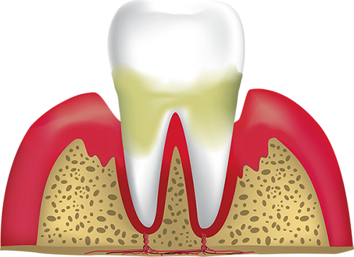 periodontitis, Falmouth, MA