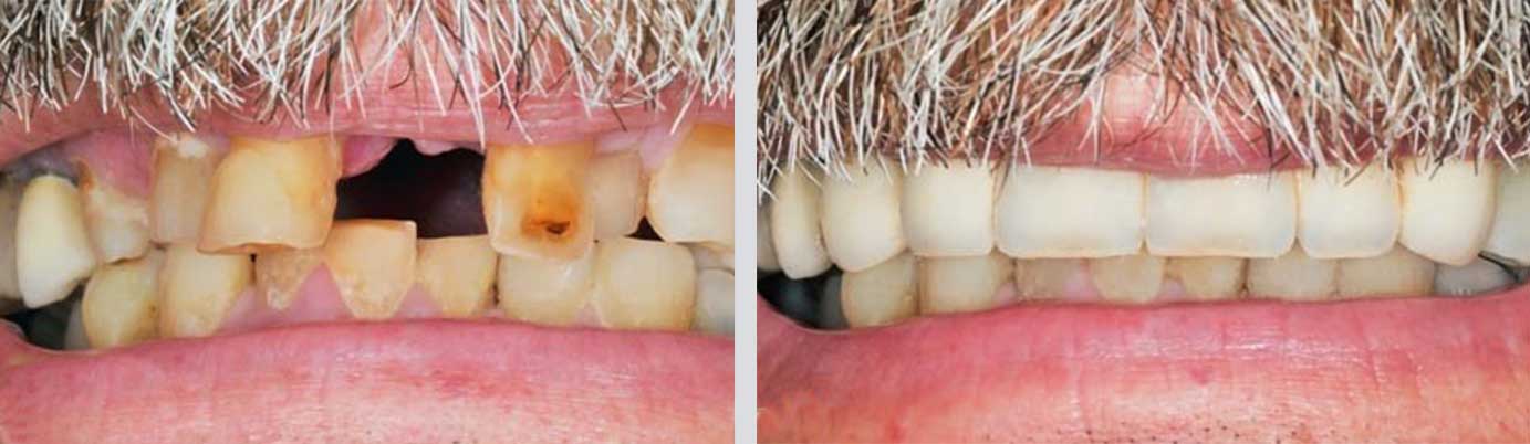 dental implants before and after, Falmouth, MA