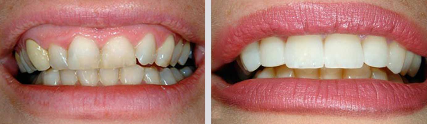 cosmetic before and after teeth, Falmouth, MA